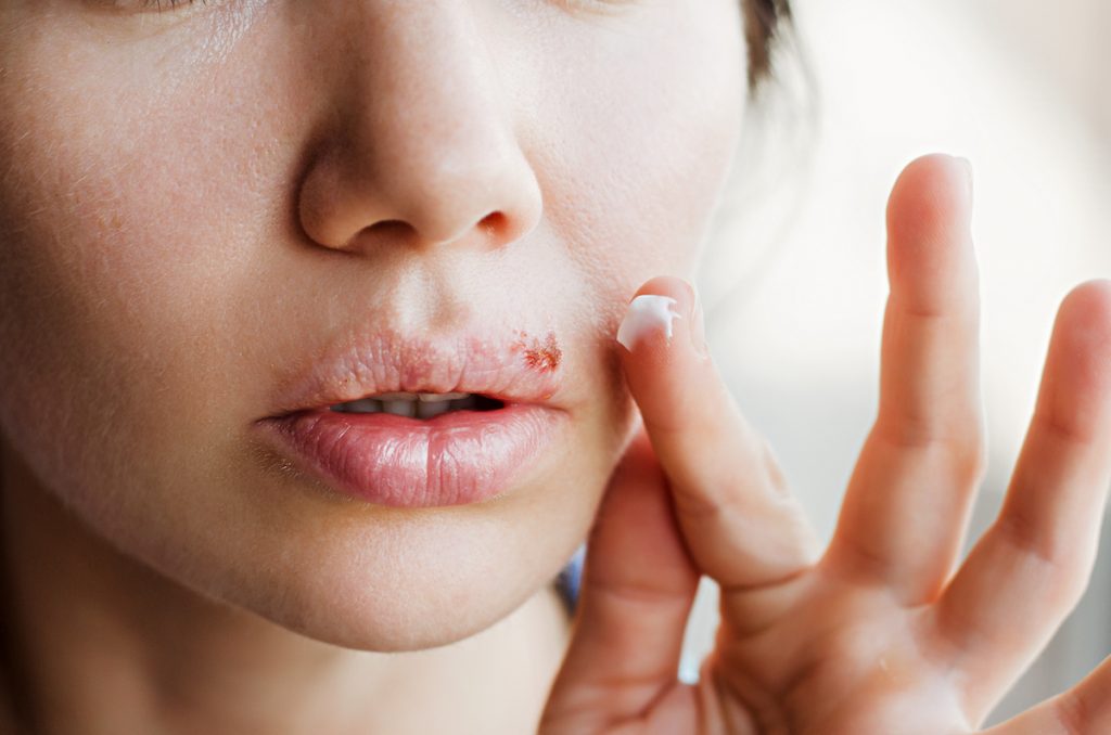 herpes Las peores enfermedades que puedes contraer en un gimnasio sucio | Zestradar