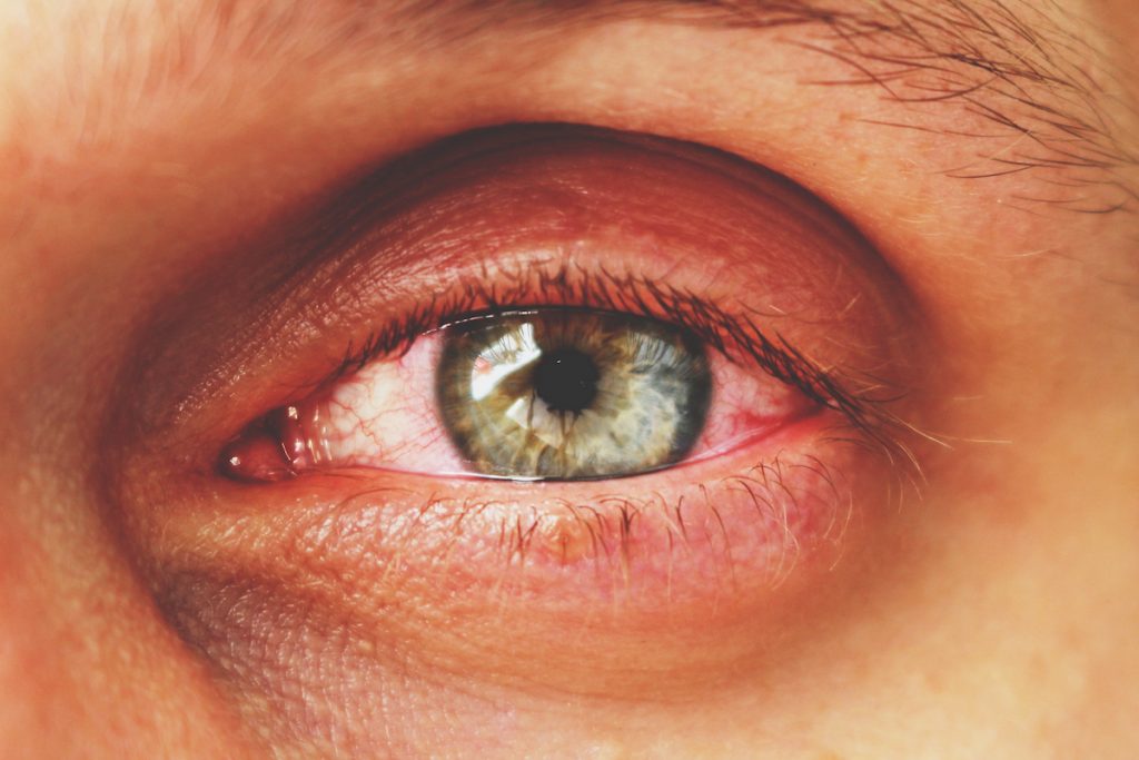 Conjuntivitis |: Las peores enfermedades que puedes contraer en un gimnasio sucio | Zestradar