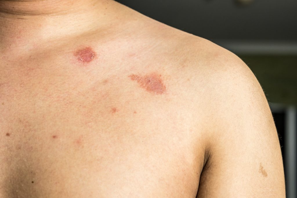 Gusano anular |: Las peores enfermedades que puedes contraer en un gimnasio sucio | Zestradar